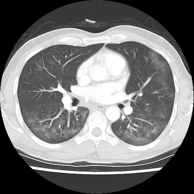 Administering Inhaled Pentamidine and Precautions to Take